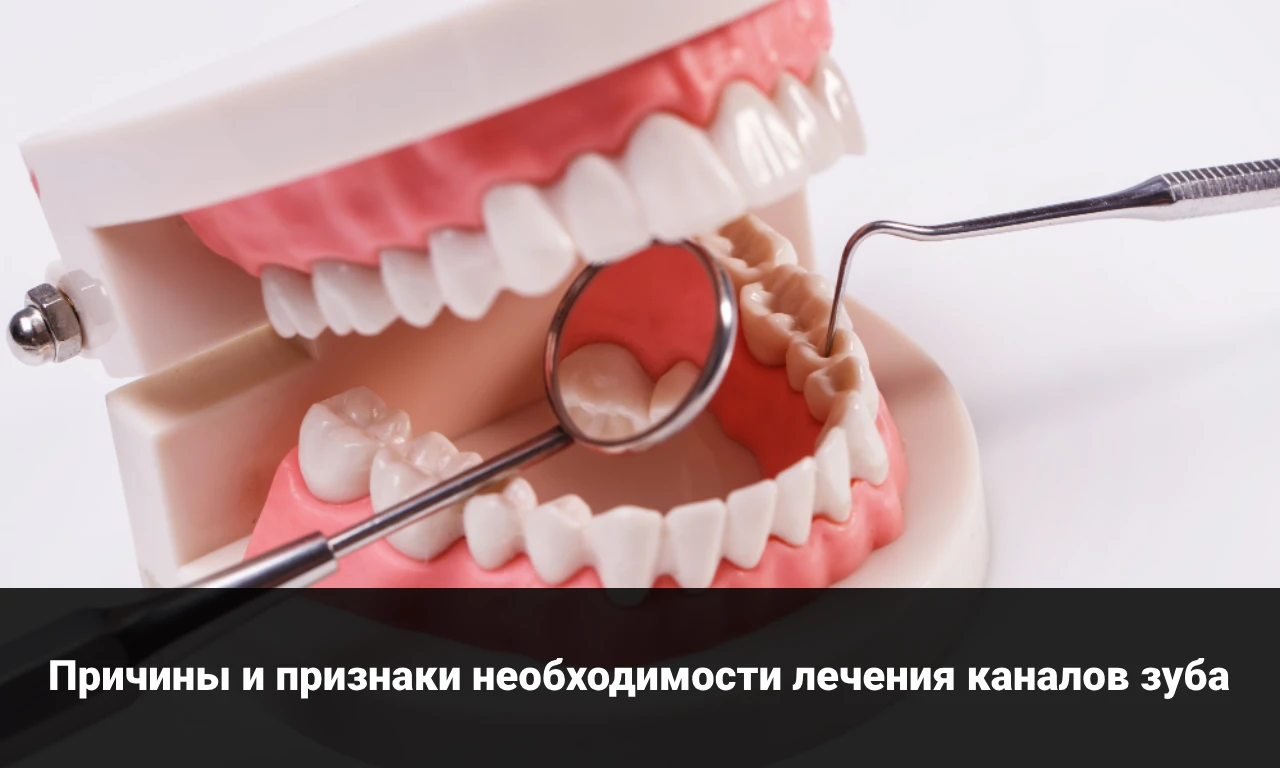 Причины и признаки необходимости лечения каналов зуба